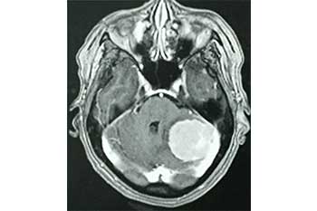 Meningioma